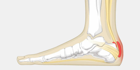 Achilles Bursitis - The Complete Injury Guide