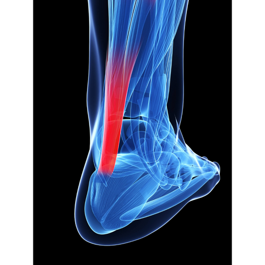 Achilles Tendonitis | Causes &amp; Treatments