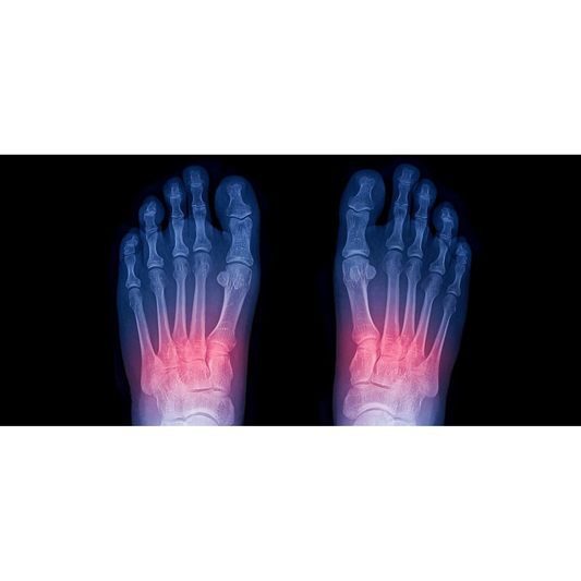 Lisfranc Injuries &amp; Fractures