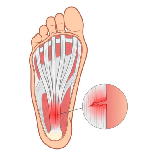 Plantar Fasciitis: The Complete Guide