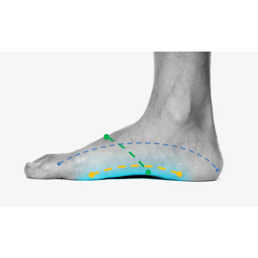 What is Flat Feet or Fallen Arches?