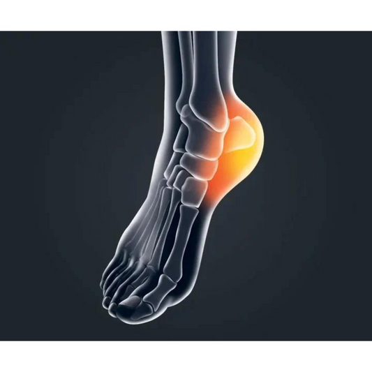 10 Most Likely Causes of Heel Pain