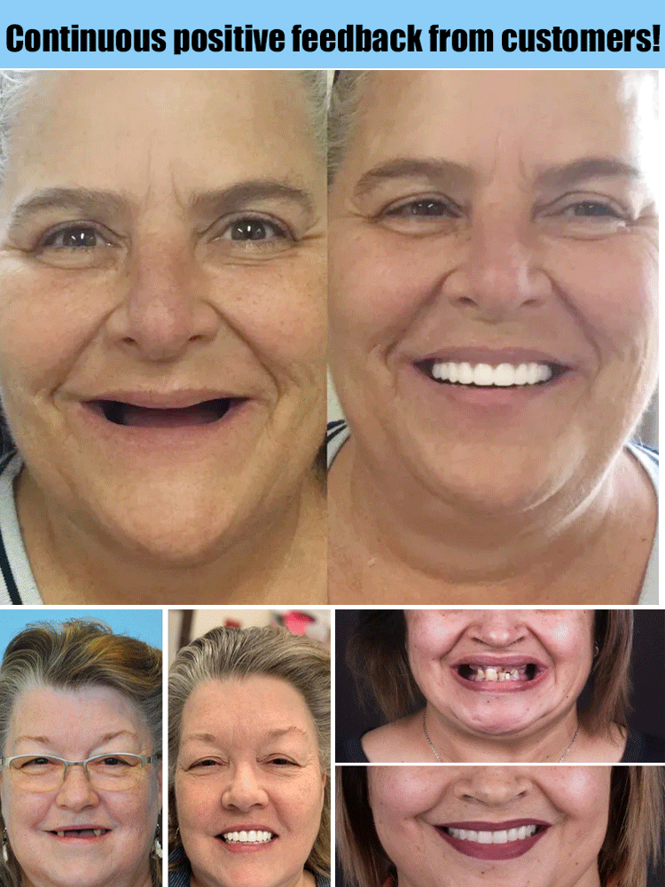 Flexible Denture Set for Upper & Lower Jaw – Reusable & Custom-Fit — photo 3