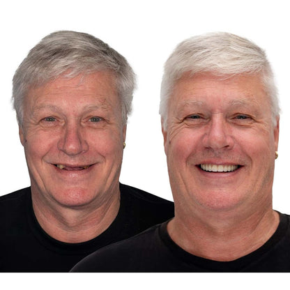 Removable Full Arch Denture Set with Flexible Cushion Grip for Everyday Wear — photo 5