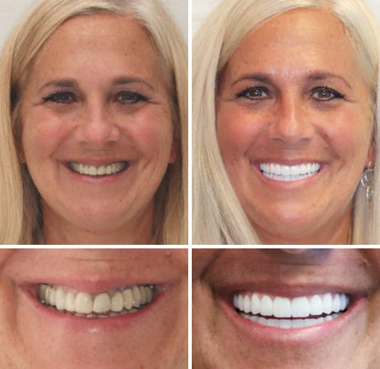 Unisex Personalized Full Dentures – Natural Look Ivory & White