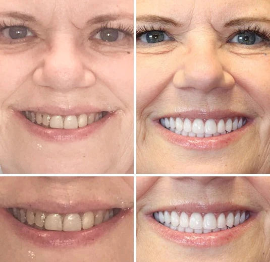 Unisex Personalized Full Dentures – Natural Look Ivory & White